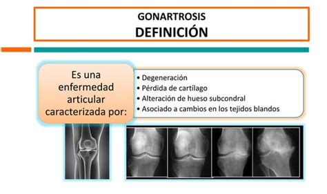 Rodilla Degenerativa Expo De Gonartrosis Ppt