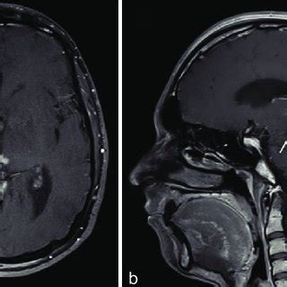 A 16 Year Old Boy Presented With The Left Sided Weakness And Unsteady