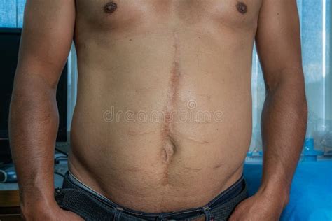 Male Patient With Abdominal Surgical Scar Stock Image Image Of