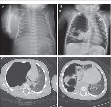 Figure From Type I Pleuropulmonary Blastoma Originating From An