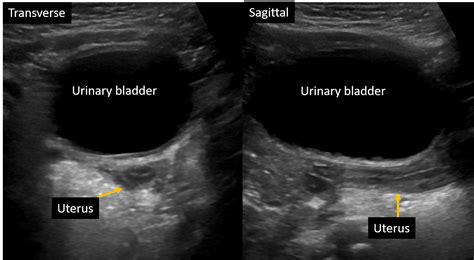 Sonography Pediatric Gynecology Assessment Protocols And