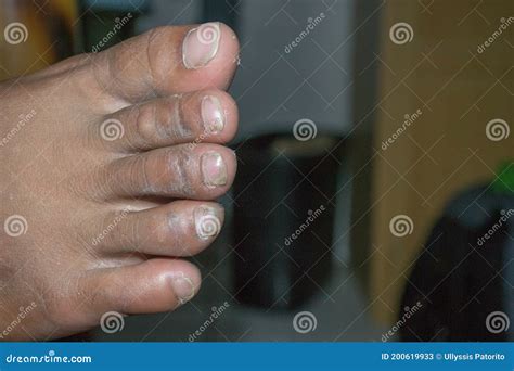 Callused And Dirty Foot Of A Man With Long And Dirty Finger Nails Stock