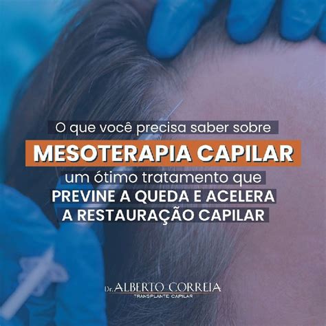 Mesoterapia Capilar Quanto Custa Doutor Alberto Correia