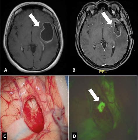 2 A Preoperative Axial T1 Weighted Image After A Contrast