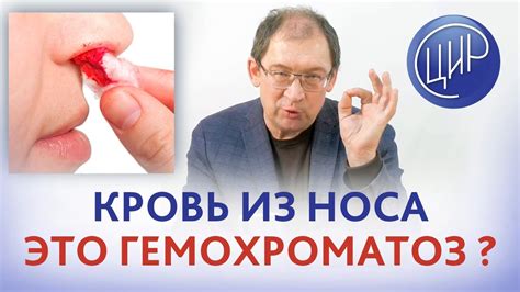 Носовые кровотечения и гемохроматоз. Являются ли носовые кровотечения ...