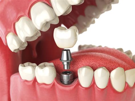 Cost of Dental Implants Baltimore MD | Teeth Implants