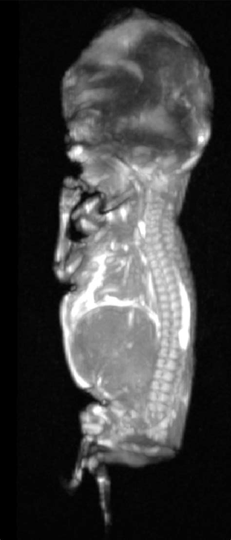 Limits Of Body Post Mortem Mri Pmmr Threedimensional Reconstruction