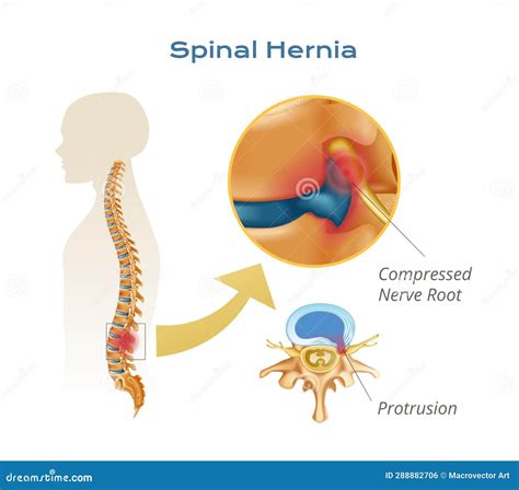 Spinale Hernia Anatomie Infografieken Vector Illustratie Illustration