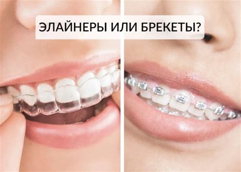 Поставить элайнеры (капы) на зубы в Москве в клинике Семейный доктор