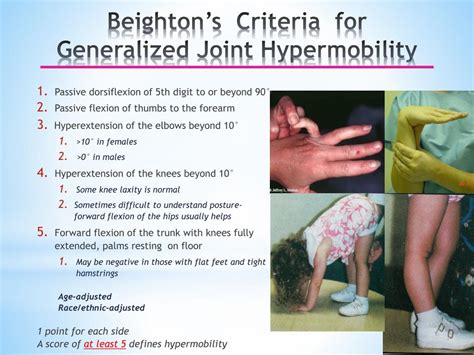 A Deep Dive Into Benign Joint Hypermobility Syndrome