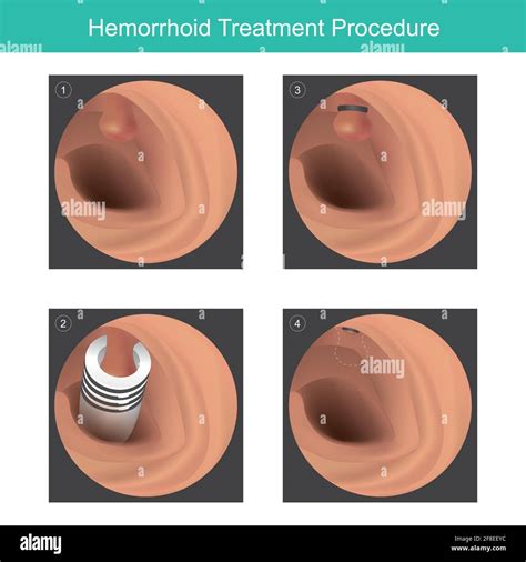 Hemorrhoid Treatment Procedure 3d Illustration For Medical Use About