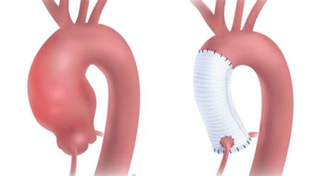 Best Bentall Procedure Doctors And Hospitals In India