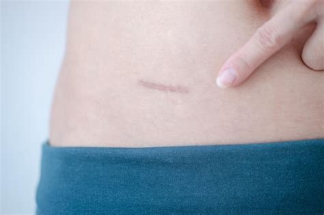 premium photo closeup  scars  appendix surgery