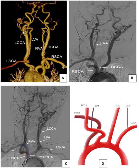 frontiers case report  vertebral  carotid artery anomalies