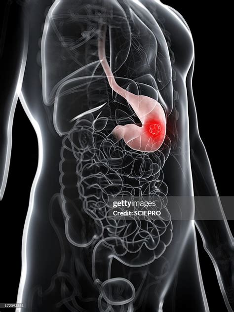 Stomach Cancer Artwork High-Res Vector Graphic - Getty Images