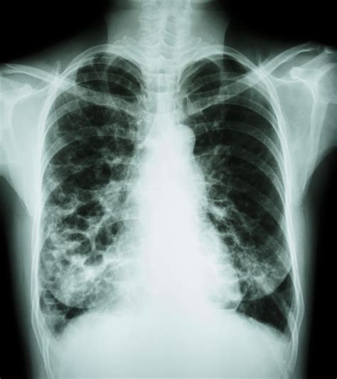 Abnormal Chest X Ray Images