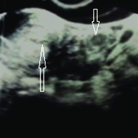 Transvaginal Sonography Revealed Intrauterine Pregnancy Long Arrow Download Scientific