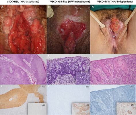 Vulvar Squamous Cell Carcinoma Arising On Human Papillomavirus