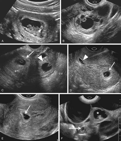 Ovarian Ectopic Pregnancy Ultrasound
