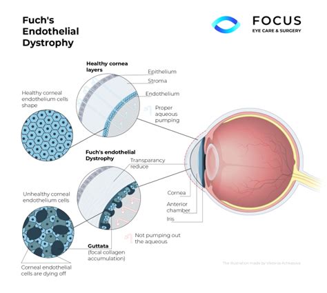 Fuchs Endothelial Dystrophy Focus Eyecare And Surgery