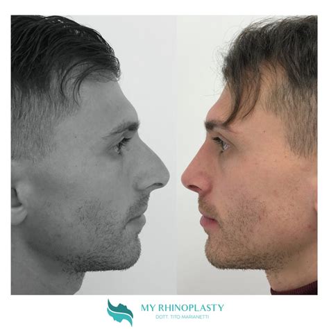 Rinoplastica Intervento Naso My Rhinoplasty