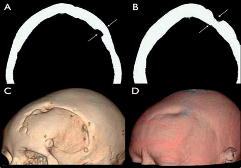 Craniotomy Burr Hole Defects A Pictures Of Hole 2018