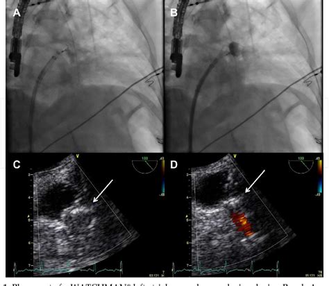 Figure From Ct Imaging To Assess The Left Atrial Appendage Anatomy