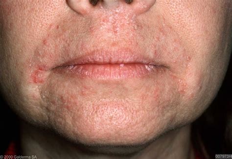 Perioral Dermatitis Images Pictures Photos