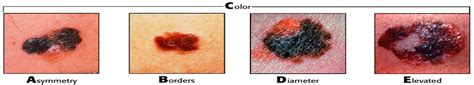 patient education guide melanoma nursing