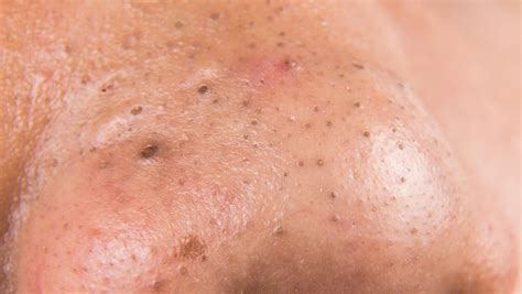 The Right Way To Get Rid Of Blackheads, According To A Dermatologist ...