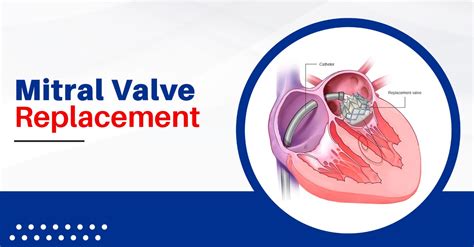 mitral valve replacement healingvalves