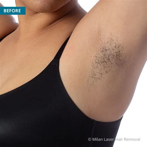 Underarm Before After Photos Of Laser Hair Removal Milan Laser