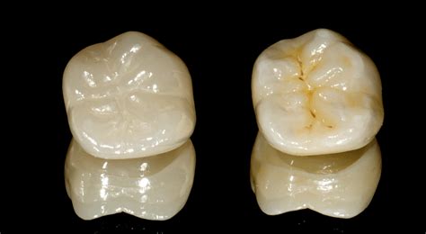 Polishing Vs Glazing Dental Ceramics Digital Dentistry Blog Idd