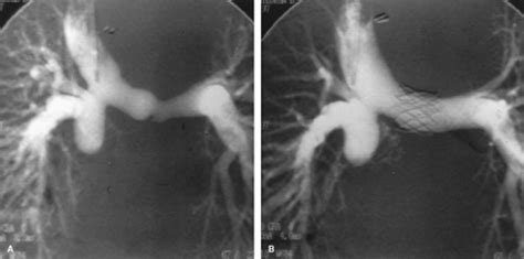 Pulmonary Stenosis Musculoskeletal Key