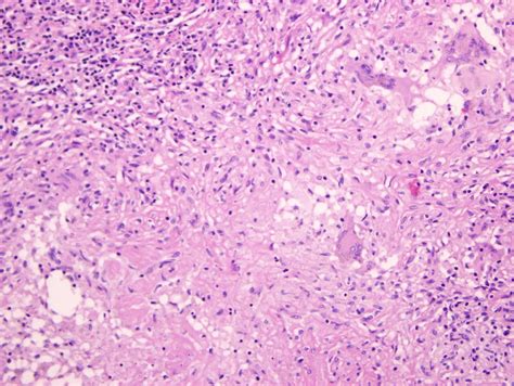 GO BIG or GO HOME: Pulmonary aspergilloma