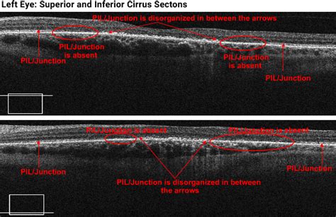 Plaquenil Induced Retinal Toxicity Page Of Retina Revealed