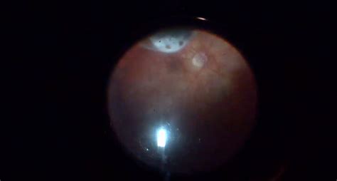 Combined Procedure for High Myopia and Chronic Retinal Detachment - Eyetube