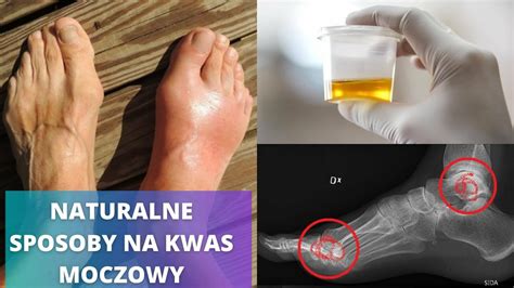 Obniż KWAS MOCZOWY naturalnymi produktami Najlepsze domowe sposoby CDA