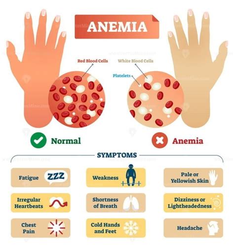 Anemia vector illustration - VectorMine