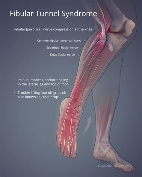Peripheral Nerve Surgery | Department of Neurosurgery