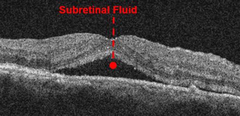 A Complete List Of Ocular Diseases With Optical Coherence Tomography Oct