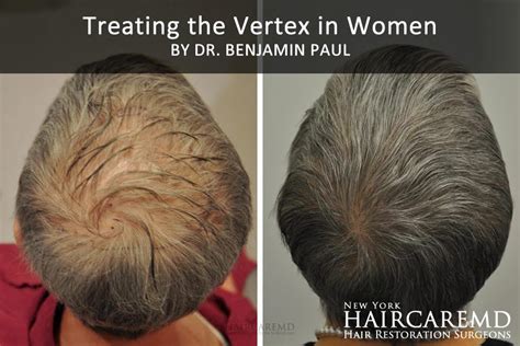 Treating The Vertex In Women Haircaremd Hair Restoration Surgeons