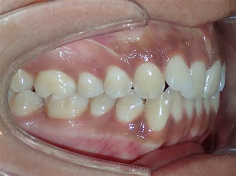 Before & Afters | Century Orthodontics