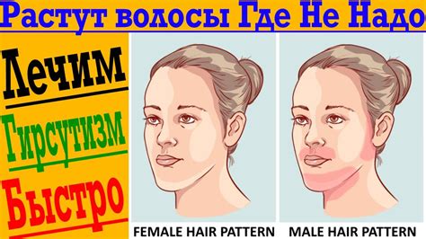 Растут волосы Где НЕ НАДО! Гирсутизим - избыточный рост волос! - YouTube