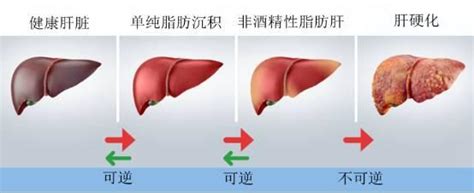 多圖讀懂肝硬化的影像學表現 每日頭條