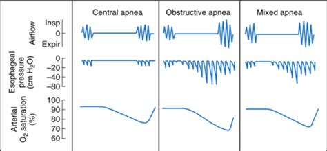 Sleep Apnea Obesity Hypoventilation Syndrome Flashcards Quizlet