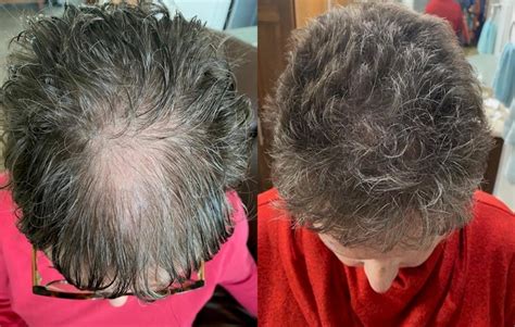 NeoGraft Before After Photos Patient 170 Tucson AZ Foothills