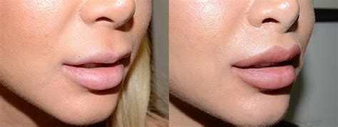 Patient 11863 Upper Lip Lift Lip Sculpting Repair Before And After