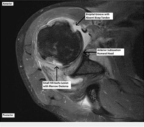 Figure 4 From A Rare Case Of Rotator Cuff Interposition Causing Humeral