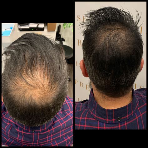 Pin on Scalp Micro-Pigmentation
